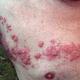 Illustration for article titled obat herpes de nature